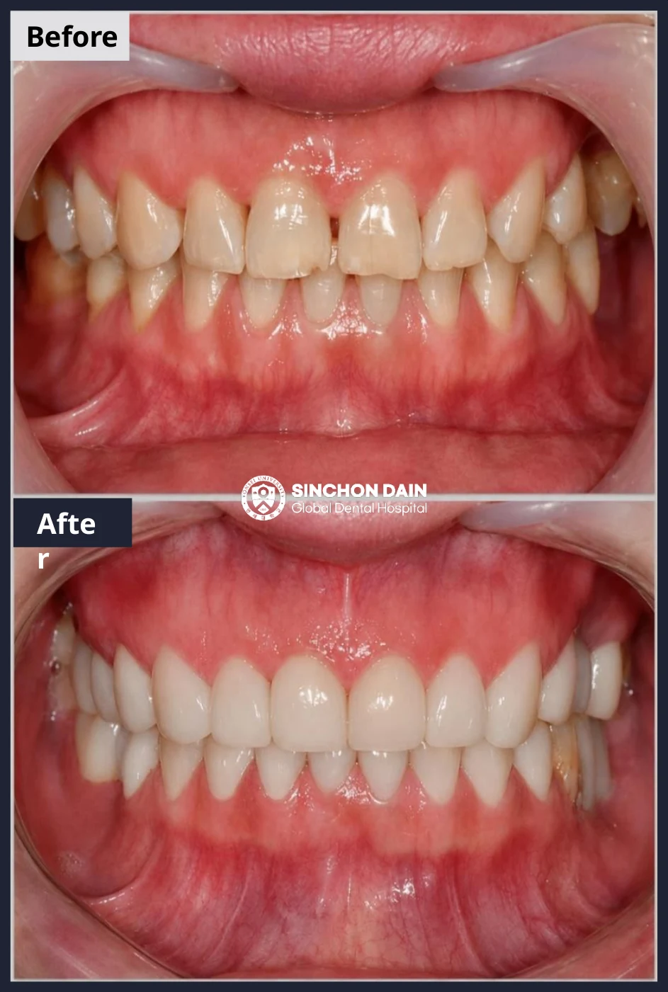 16 顆瓷牙貼片 · 案例 07: 治療前 / 治療後
